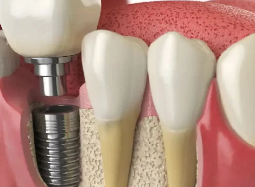 Simple Tips For Maintaining Results After Teeth Whitening